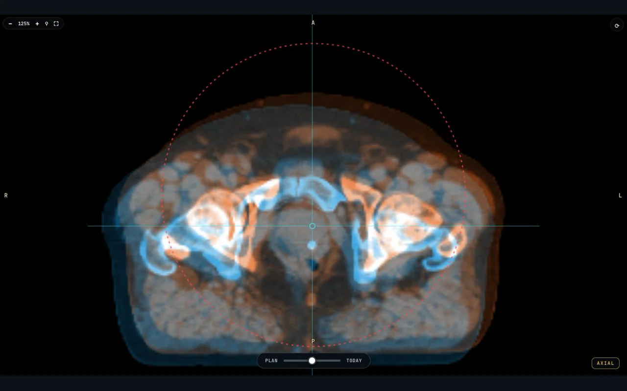 Close axial view of a fictional offset between planning CT and simulated daily CBCT