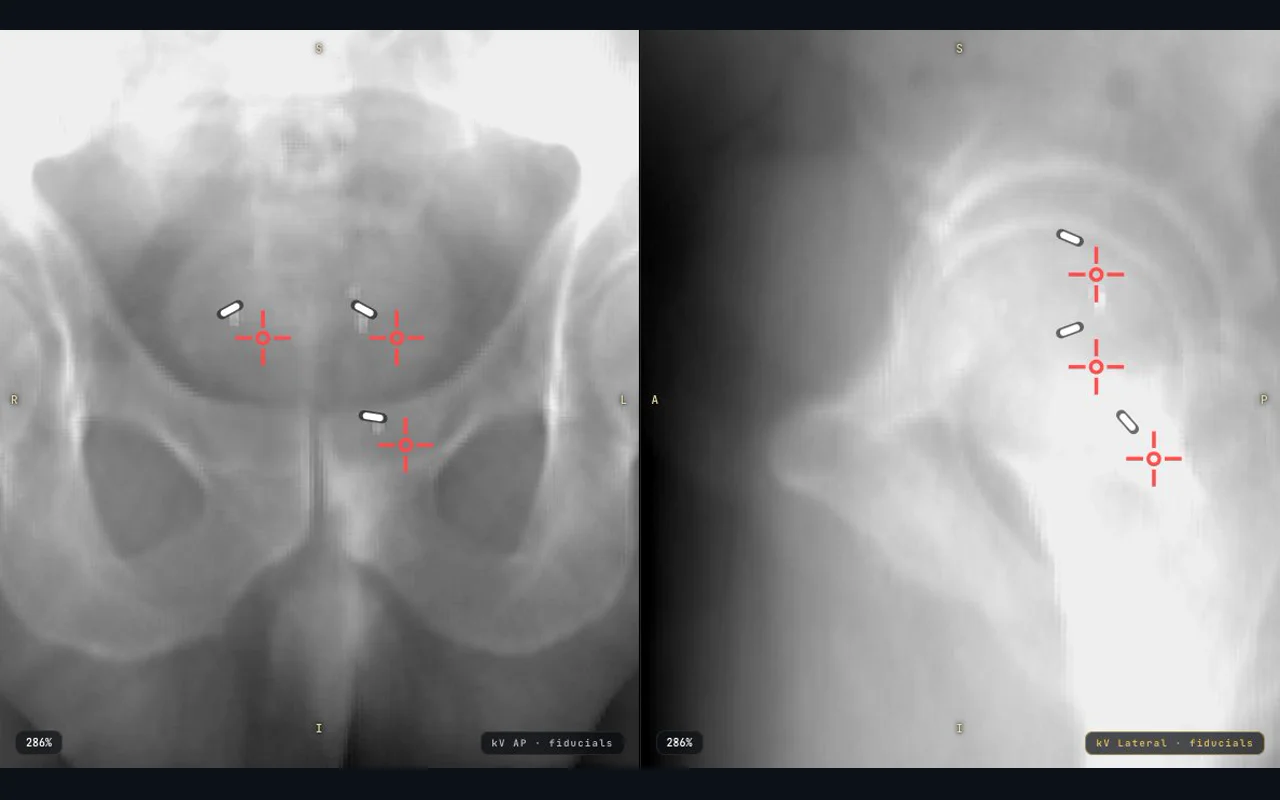 Before: red guides offset from the fiducials in AP on the left and lateral on the right