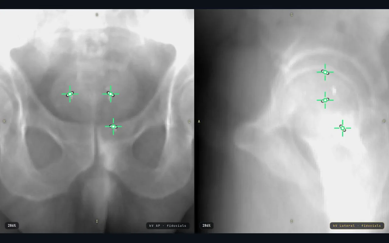 After: green guides centered on all three fiducials in both the AP and lateral views