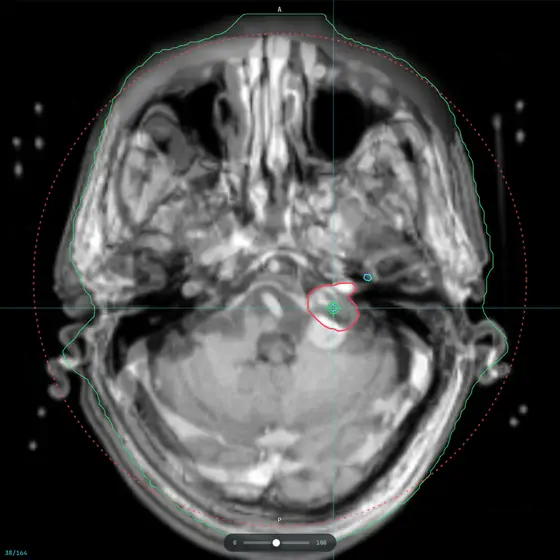 Axial contrast MR at the internal auditory canal with a teaching target