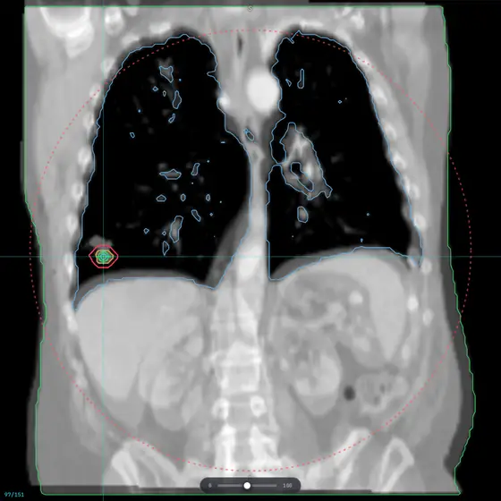 Coronal lung CT with a right lower lobe target contour