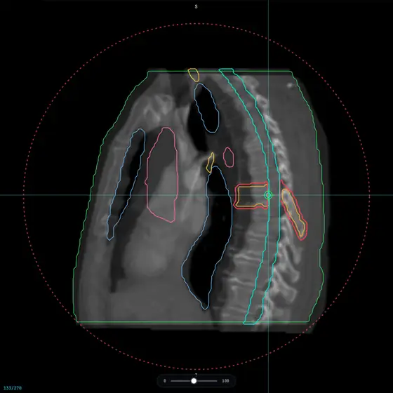 Sagittal thoracic spine CT with target and organ-at-risk contours